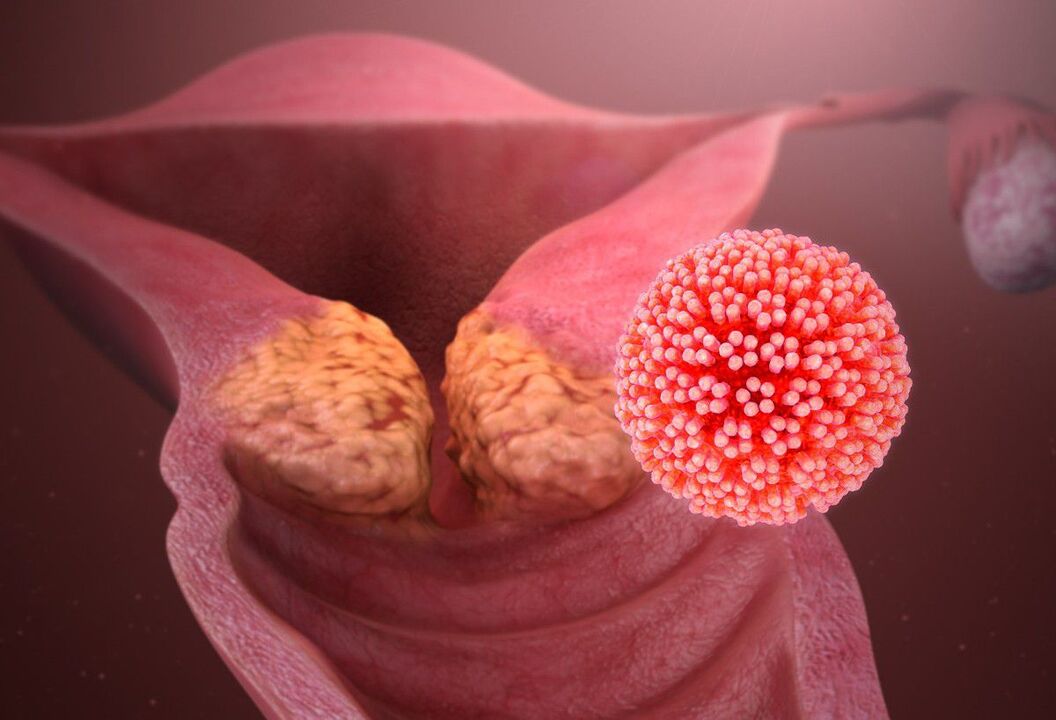 Lesión por VPH do colo do útero
