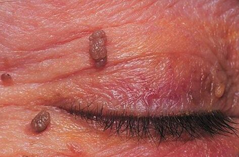 Papilomas na pel das pálpebras que requiren tratamento