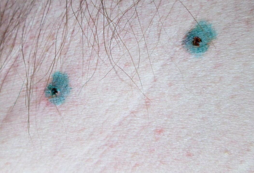 Manchas na pel despois da eliminación con láser de papilomas